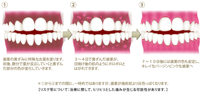 大阪で歯茎の黒ずみ取りは大阪市の大阪中央審美歯科ホワイトニングサロンへ 歯茎の黒ずみ除去